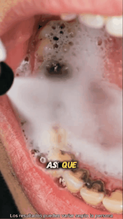 SPRAY BUCAL/ALIVIO RAPIDO Y SEGURO A TUS DIENTES Y ENCIAS  + ENVIO GRATIS A TODO GUATEMALA 🎁